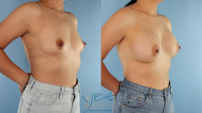 Before & After Breast Augmentation Case 516 Right Oblique View in Vancouver, BC