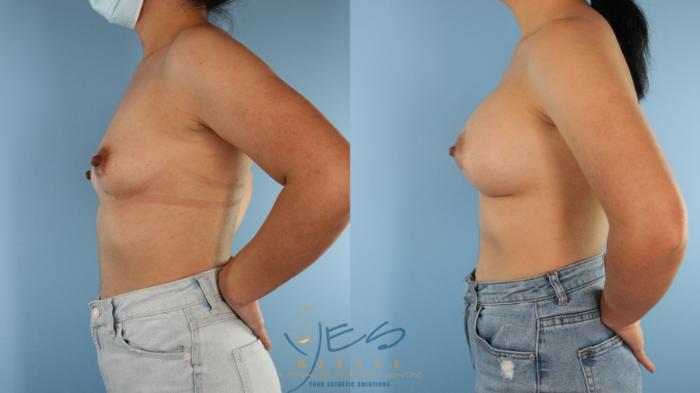Before & After Breast Augmentation Case 516 side View in Vancouver, BC
