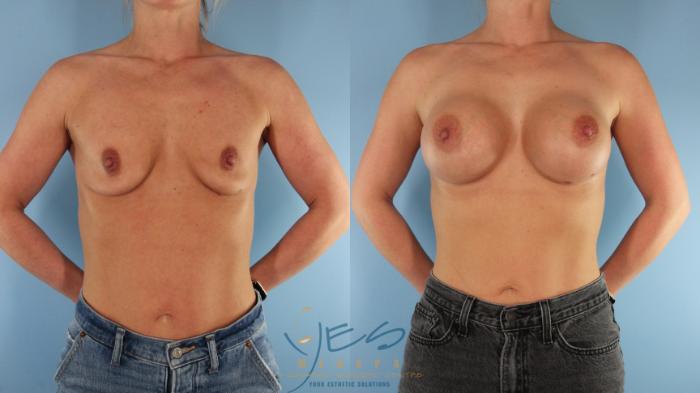 Before & After Breast Augmentation Case 517 Front View in Vancouver, BC