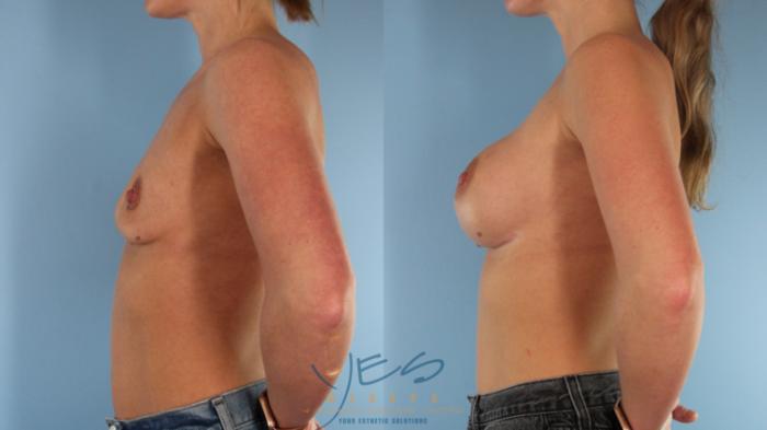 Before & After Breast Augmentation Case 517 Left Side View in Vancouver, BC