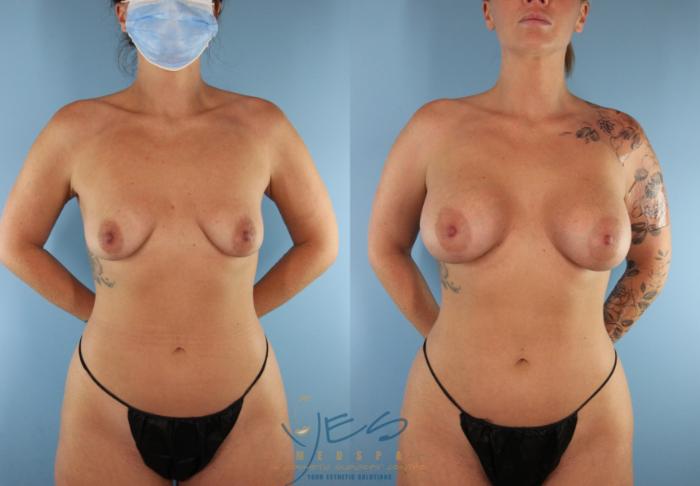 Before & After Breast Augmentation Case 519 Front View in Vancouver, BC