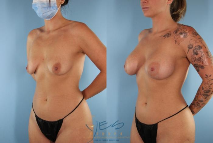 Before & After Breast Augmentation Case 519 Left Oblique View in Vancouver, BC