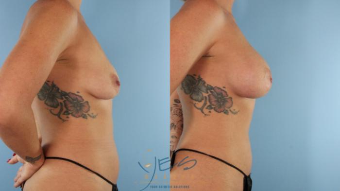 Before & After Breast Augmentation Case 519 Right Side View in Vancouver, BC