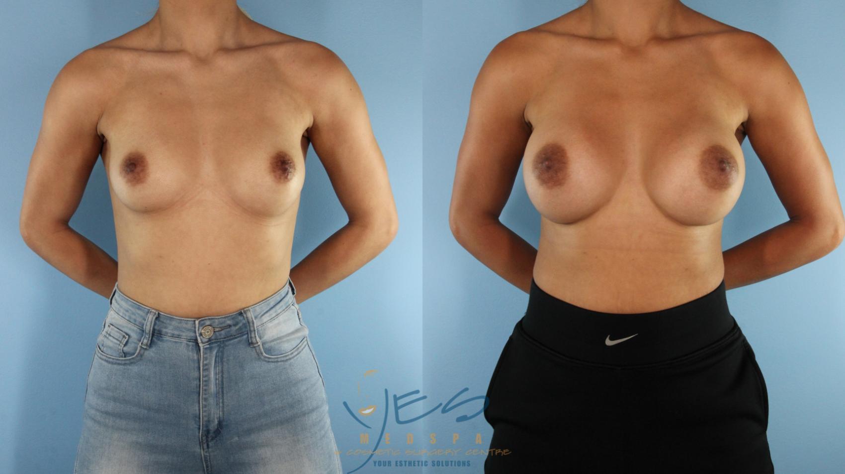 Before & After Breast Augmentation Case 521 Front View in Vancouver, BC