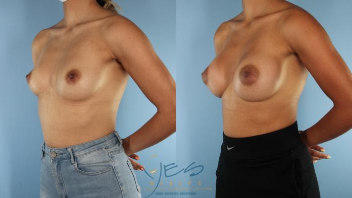 Before & After Breast Augmentation Case 521 Left Oblique View in Vancouver, BC