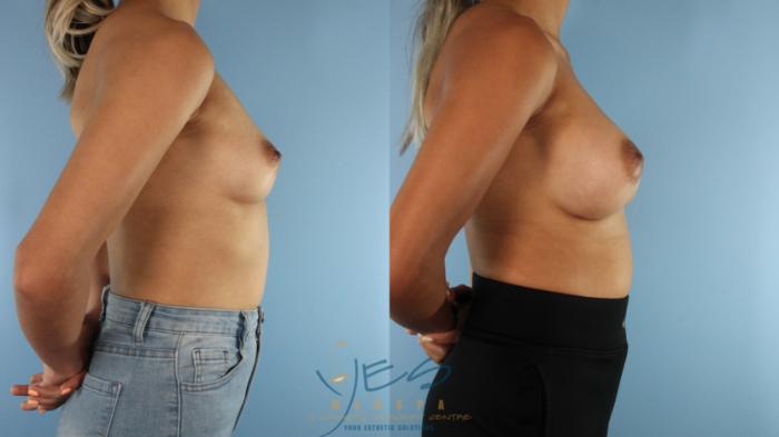 Before & After Breast Augmentation Case 521 Right Side View in Vancouver, BC