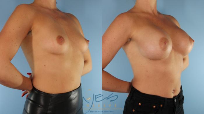 Before & After Breast Augmentation Case 522 Right Oblique View in Vancouver, BC