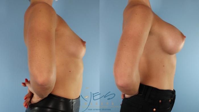Before & After Breast Augmentation Case 522 Right Side View in Vancouver, BC
