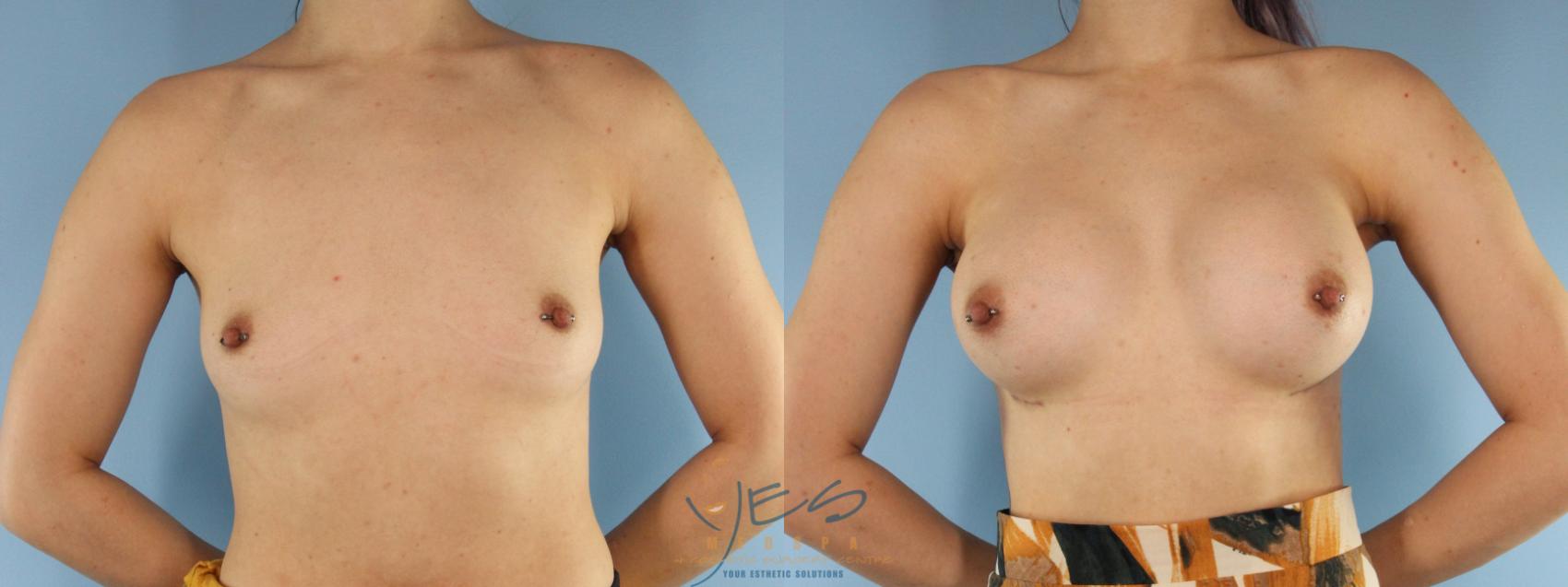 Before & After Breast Augmentation Case 523 Front View in Vancouver, BC