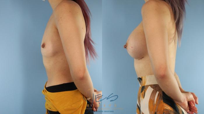 Before & After Breast Augmentation Case 523 Left Side View in Vancouver, BC