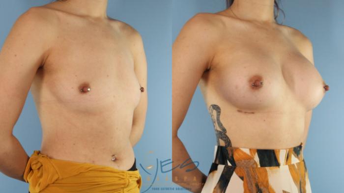 Before & After Breast Augmentation Case 523 Right Oblique View in Vancouver, BC