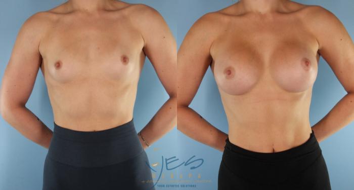 Before & After Breast Augmentation Case 525 Front View in Vancouver, BC