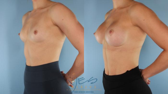 Before & After Breast Augmentation Case 525 Left Oblique View in Vancouver, BC