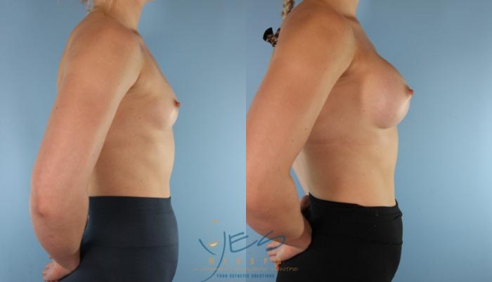 Before & After Breast Augmentation Case 525 Right Oblique View in Vancouver, BC