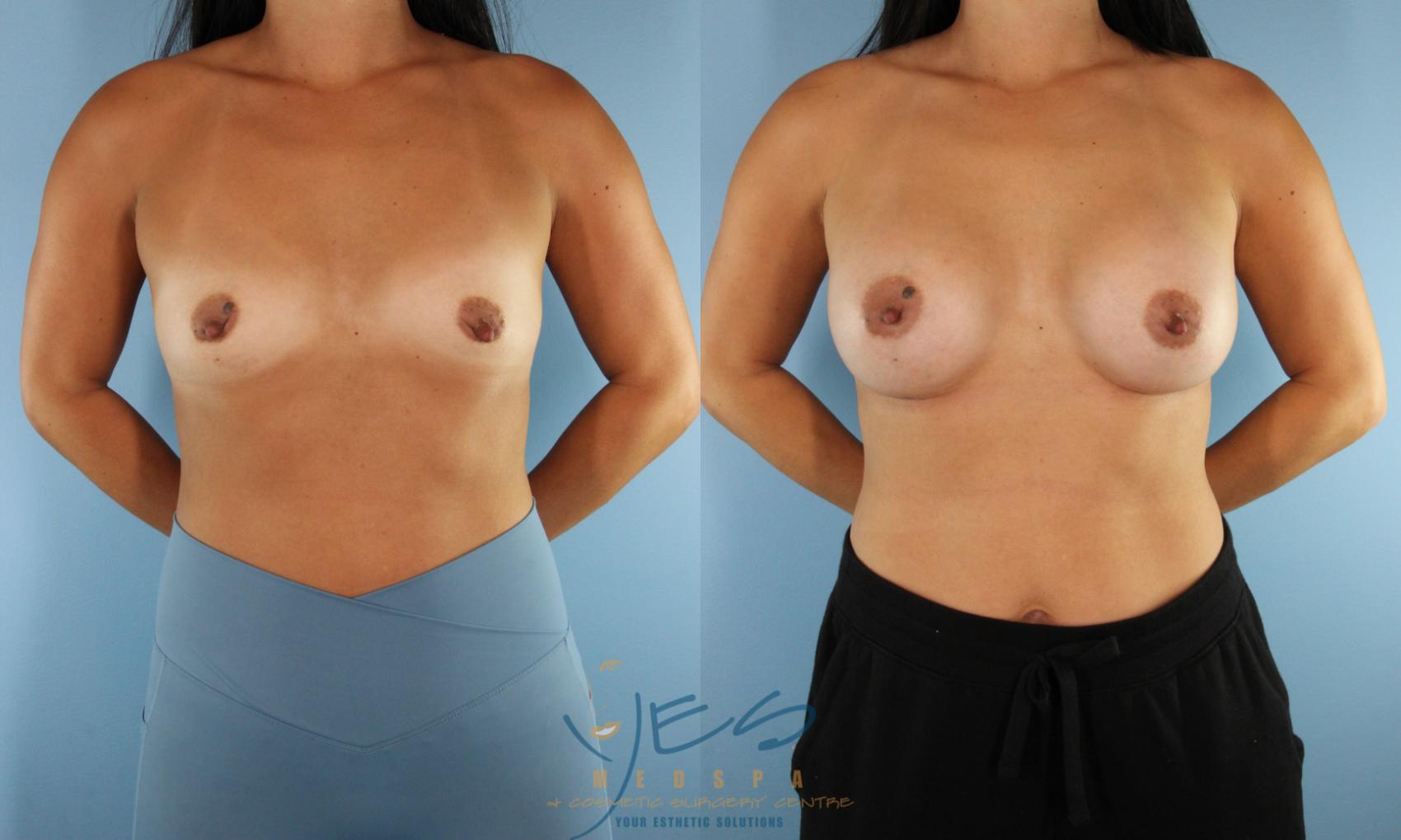 Before & After Breast Augmentation Case 526 Front View in Vancouver, BC