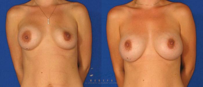 Before & After Breast Augmentation Case 54 View #1 View in Vancouver, BC
