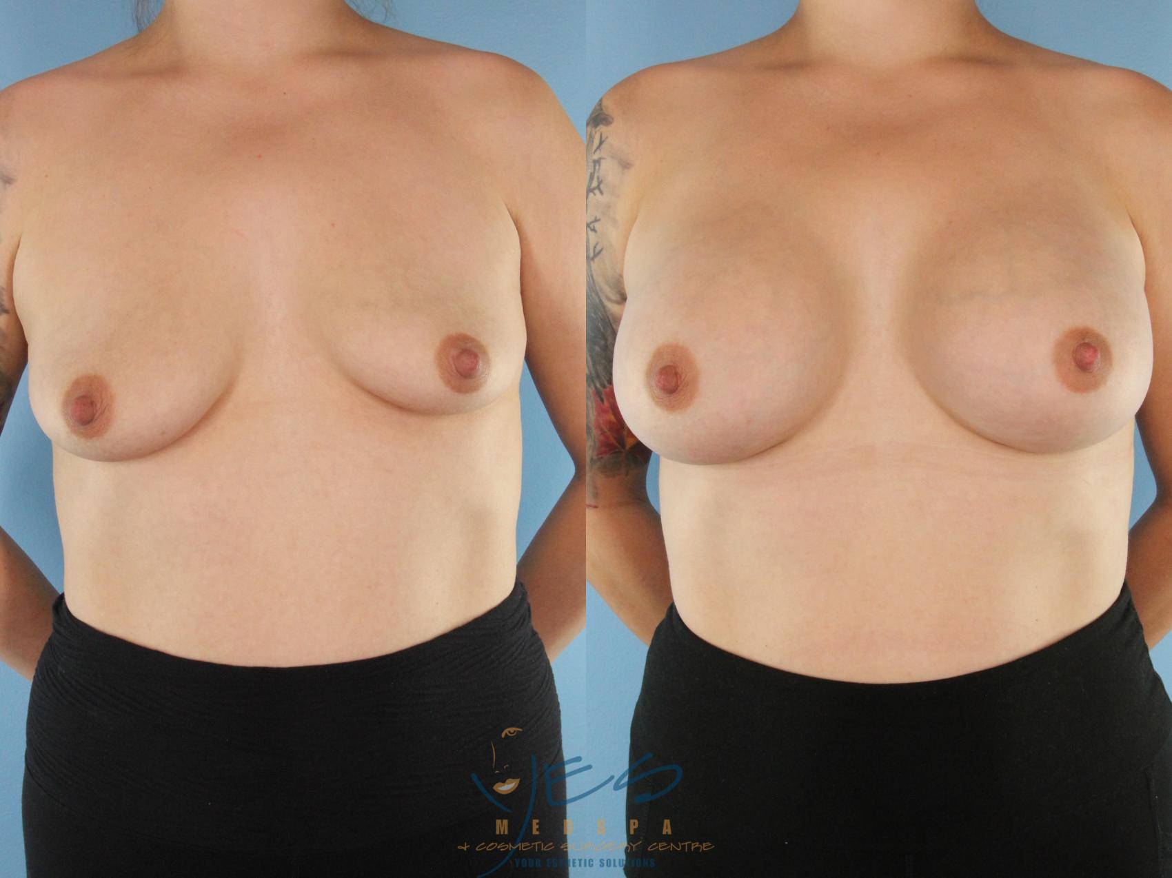 Before & After Breast Augmentation Case 559 Front View in Vancouver, BC