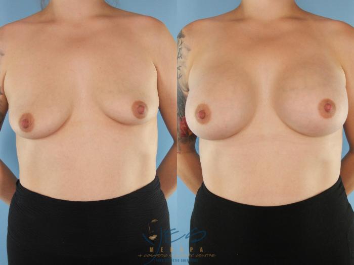 Before & After Breast Augmentation Case 559 Front View in Vancouver, BC