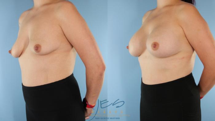 Before & After Breast Augmentation Case 559 Left Oblique View in Vancouver, BC