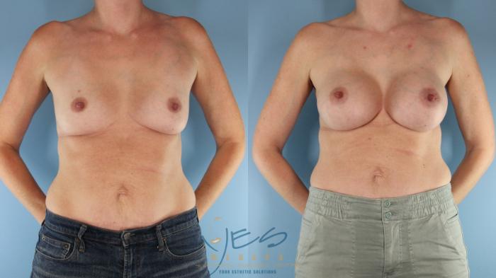Before & After Breast Augmentation Case 568 Front View in Vancouver, BC
