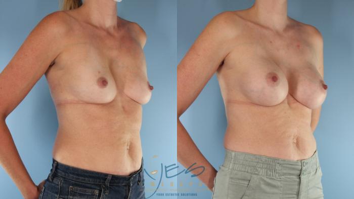 Before & After Breast Augmentation Case 568 Right Oblique View in Vancouver, BC