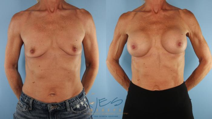Before & After Breast Augmentation Case 569 Front View in Vancouver, BC
