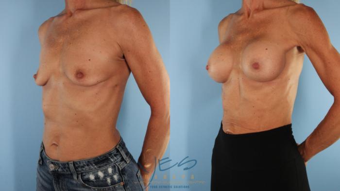 Before & After Breast Augmentation Case 569 Left Oblique View in Vancouver, BC
