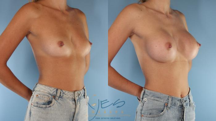 Before & After Breast Augmentation Case 570 Right Oblique View in Vancouver, BC