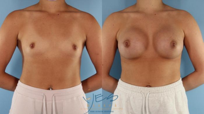 Before & After Breast Augmentation Case 572 Front View in Vancouver, BC