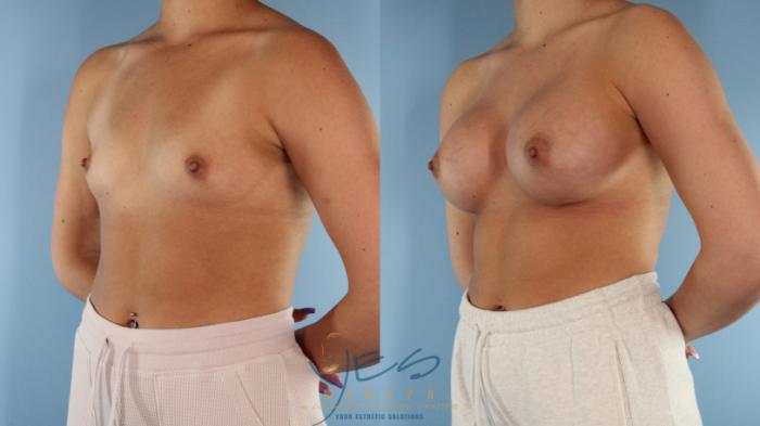 Before & After Breast Augmentation Case 572 Left Oblique View in Vancouver, BC