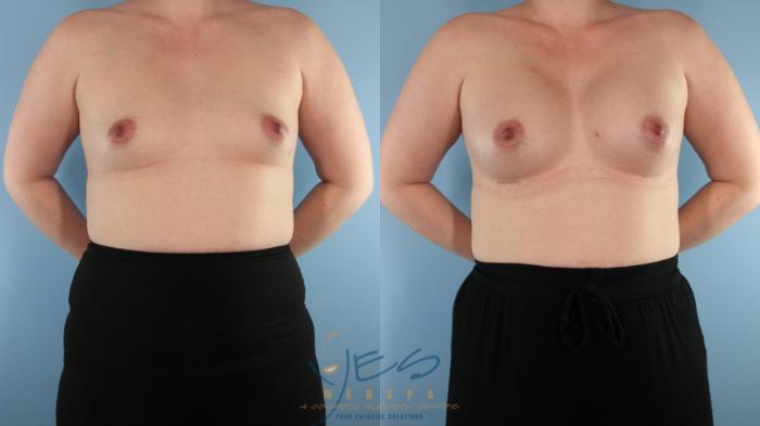 Before & After Breast Augmentation Case 573 Front View in Vancouver, BC