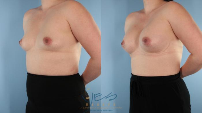 Before & After Breast Augmentation Case 573 Left Oblique View in Vancouver, BC