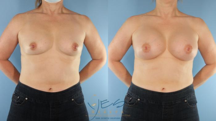 Before & After Breast Augmentation Case 574 Front View in Vancouver, BC