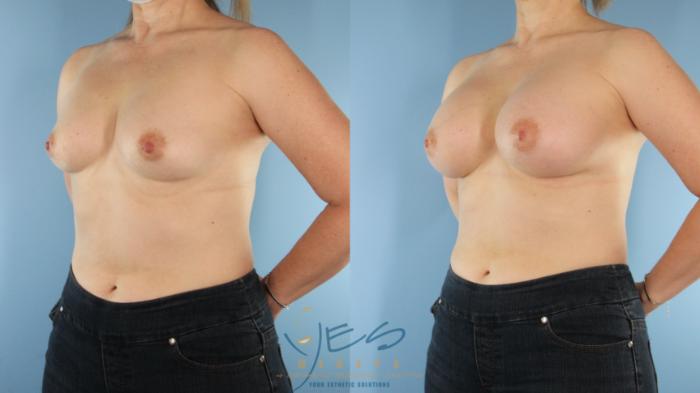 Before & After Breast Augmentation Case 574 Left Side View in Vancouver, BC