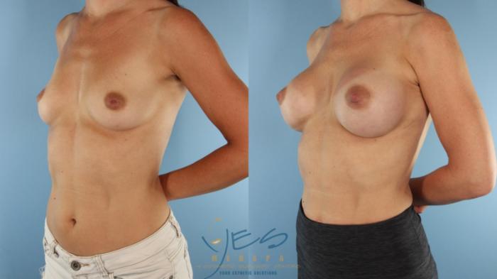 Before & After Breast Augmentation Case 575 Left Oblique View in Vancouver, BC