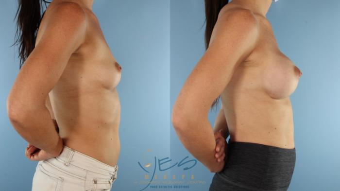 Before & After Breast Augmentation Case 575 Right Side View in Vancouver, BC