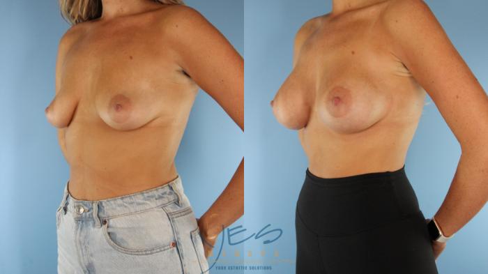 Before & After Breast Augmentation Case 576 Left Side View in Vancouver, BC