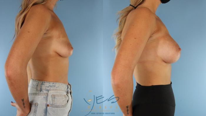 Before & After Breast Augmentation Case 576 Right Side View in Vancouver, BC