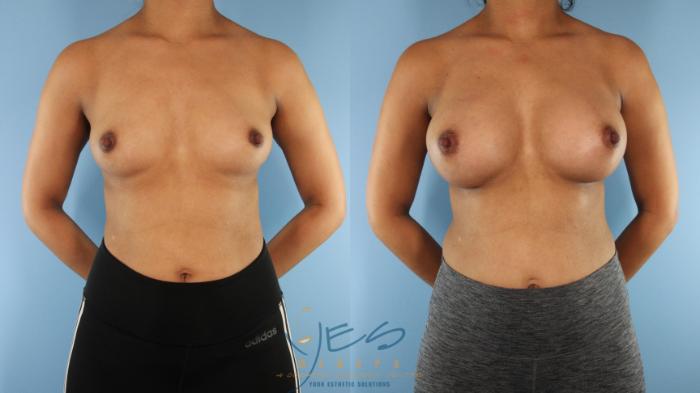 Before & After Breast Augmentation Case 577 Front View in Vancouver, BC