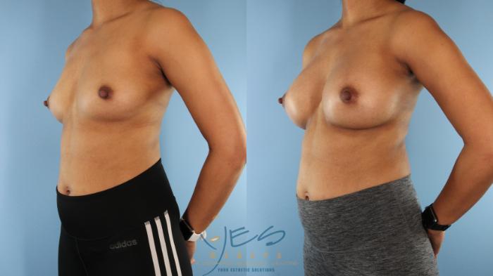 Before & After Breast Augmentation Case 577 Left Oblique View in Vancouver, BC