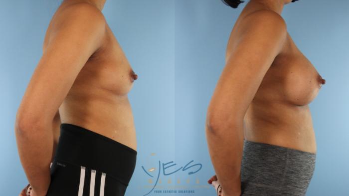 Before & After Breast Augmentation Case 577 Right Side View in Vancouver, BC