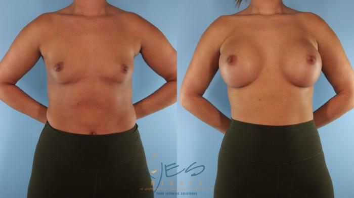 Before & After Breast Augmentation Case 578 Front View in Vancouver, BC