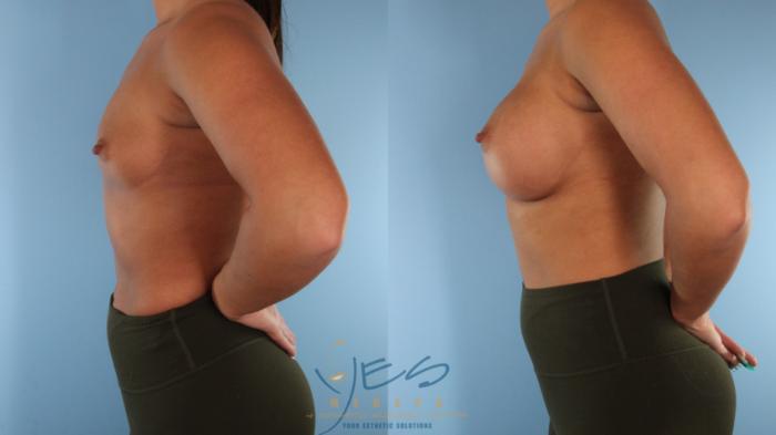 Before & After Breast Augmentation Case 578 Left Side View in Vancouver, BC
