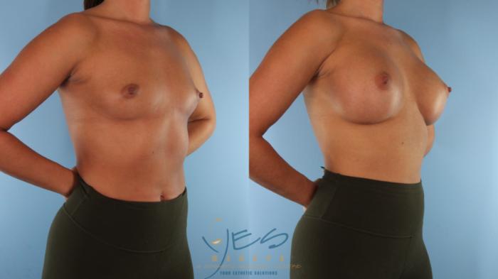 Before & After Breast Augmentation Case 578 Right Oblique View in Vancouver, BC