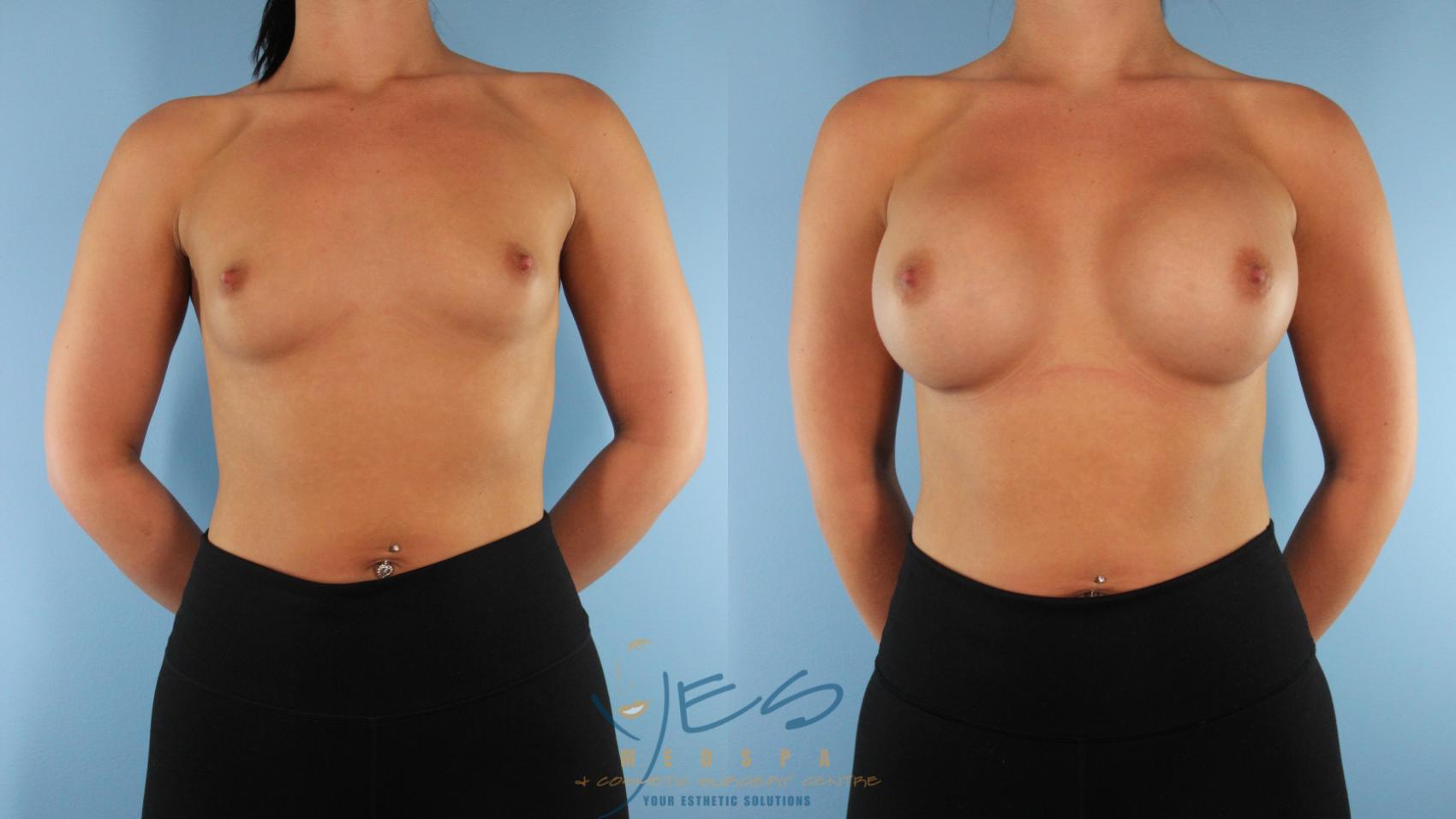 Before & After Breast Augmentation Case 579 Front View in Vancouver, BC