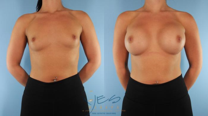 Before & After Breast Augmentation Case 579 Front View in Vancouver, BC