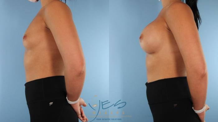 Before & After Breast Augmentation Case 579 Left Side View in Vancouver, BC