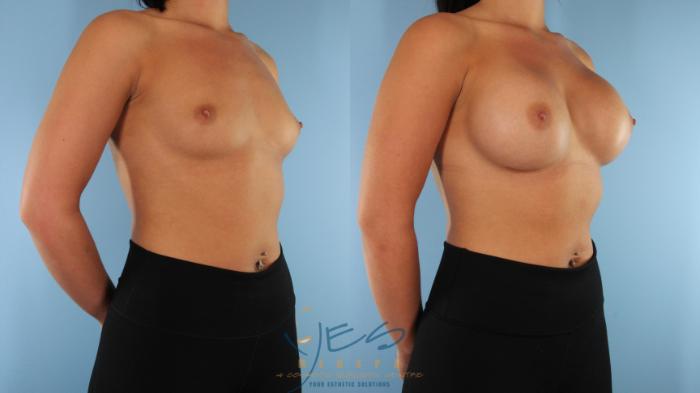 Before & After Breast Augmentation Case 579 Right Oblique View in Vancouver, BC