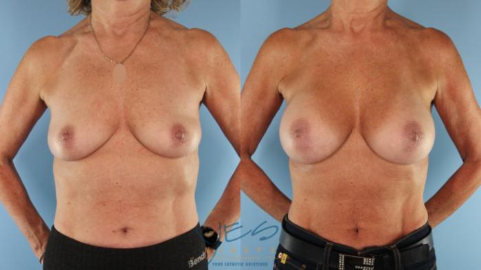 Before & After Breast Augmentation Case 587 Front View in Vancouver, BC