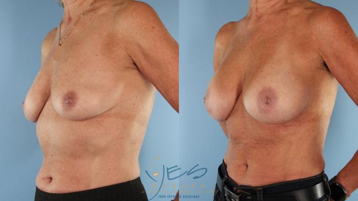 Before & After Breast Augmentation Case 587 Left Oblique View in Vancouver, BC